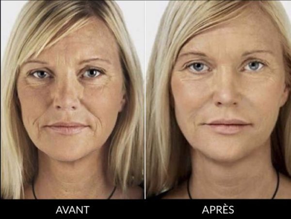 skinbooster